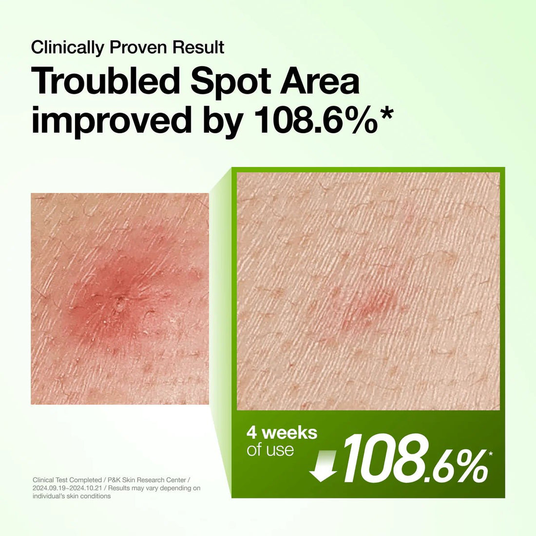 Anua – Azelaic Acid 10 Hyaluron Redness Soothing Serum, 30ml - Tūfiti
